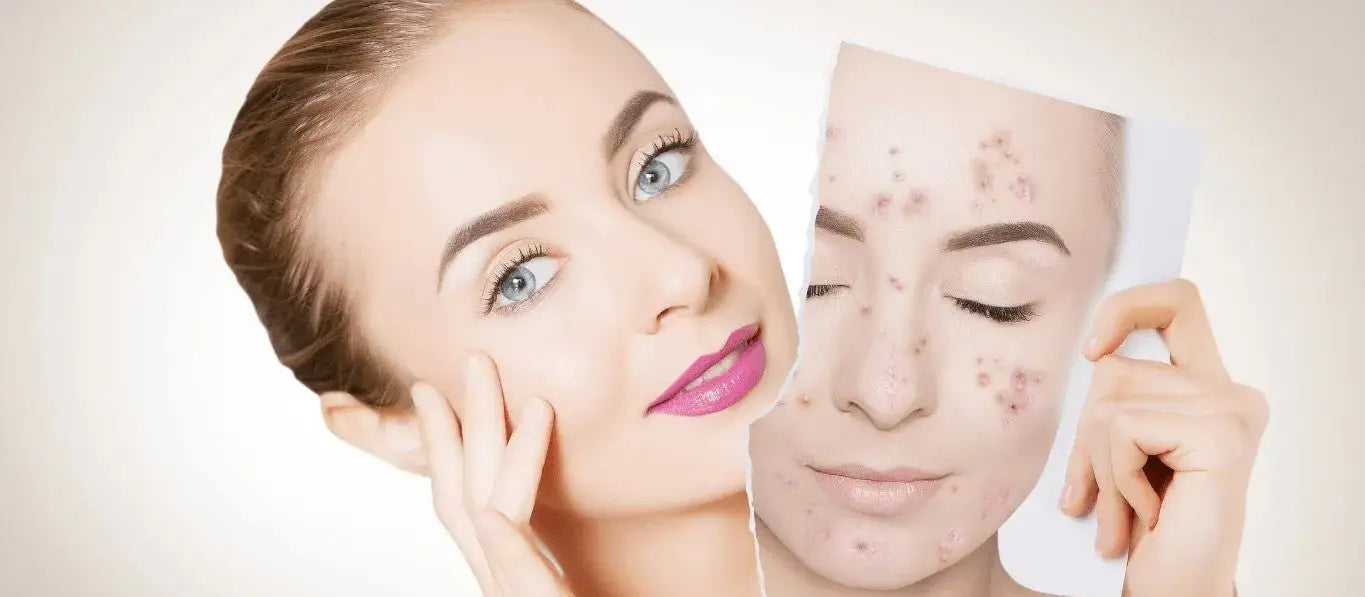 Do Hormones Affect Skin Health?